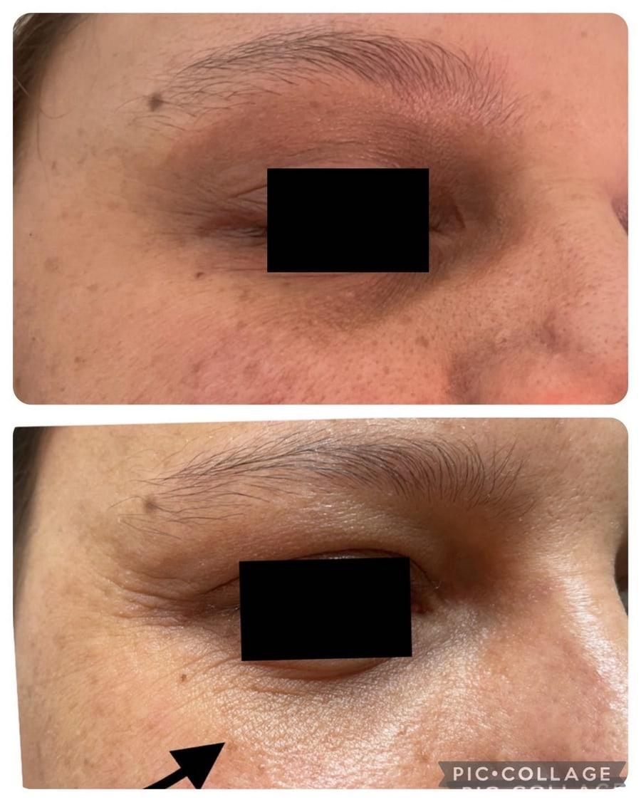 Mélasma (taches brunes) : causes et traitements